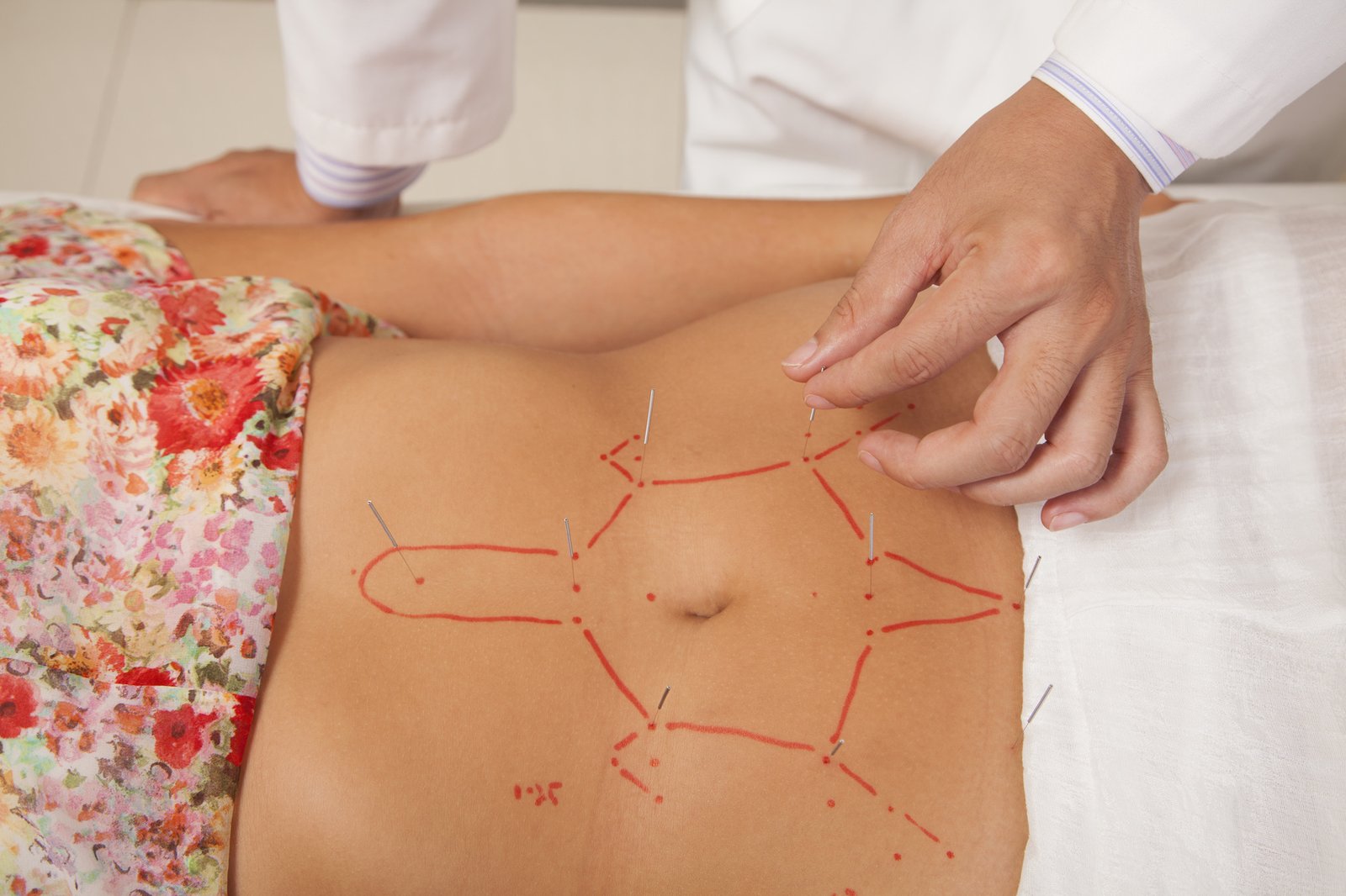 Acupuncture needle placement at Angel Holistic Acupuncture, Fairfax VA